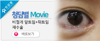 비절개앞트임+…