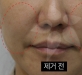 볼이물질제거