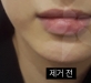 입술이물질제…