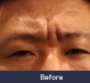 미간주름 신경…