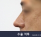 비절개 코성형 …