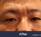 미간주름 신경…