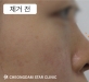 콧대이물질제…