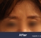 미간주름 신경…