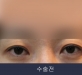 비절개 위트임+…
