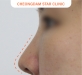 비절개 코성형