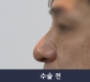 비절개 코성형 …