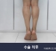 종아리신경차…