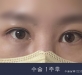 비절개 윗트임 …