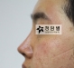 비절개 코성형