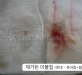 콧대이물질제…