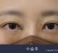 비절개 윗트임 …