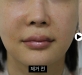 팔자필러제거