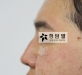 비절개 코성형