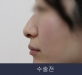 비절개코성형 …