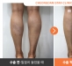 종아리신경차…