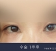 비절개 앞트임+…