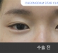 비절개 눈성형