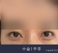 비절개 위트임+…