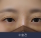 비절개 윗트임 …