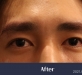 [미간주름신경…