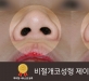 비절개코성형 …