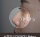비절개코성형 …
