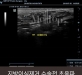 지방이식제거 …