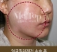 얼굴필러 이물…