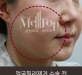 얼굴필러 이물…