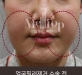 얼굴필러 이물…
