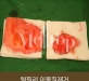 턱필러 이물질…