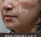 볼필러 이물질…