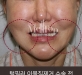 턱필러 이물질…