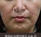 볼필러 이물질…