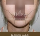 [실이물질제거]…