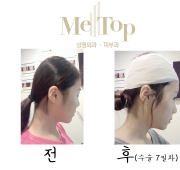 뒷통수 성형 7…