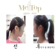 뒷통수 성형 9…