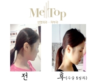 뒷통수 성형 5…