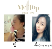 코수술 75일차