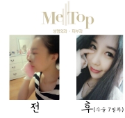 코수술 7일차