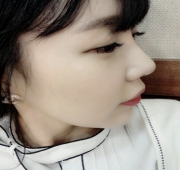 코수술 45일차