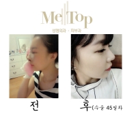 코수술 45일차