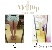 허벅지 지방흡…