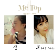코수술 2주차