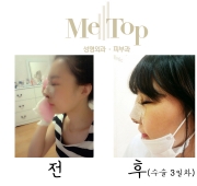 코수술 3일차