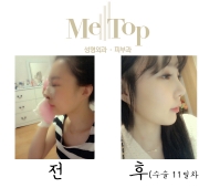 코수술 11일차