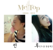 코수술 5일차