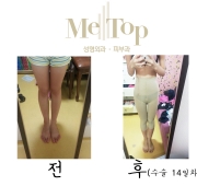 허벅지 지방흡…