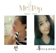 코수술 3주차